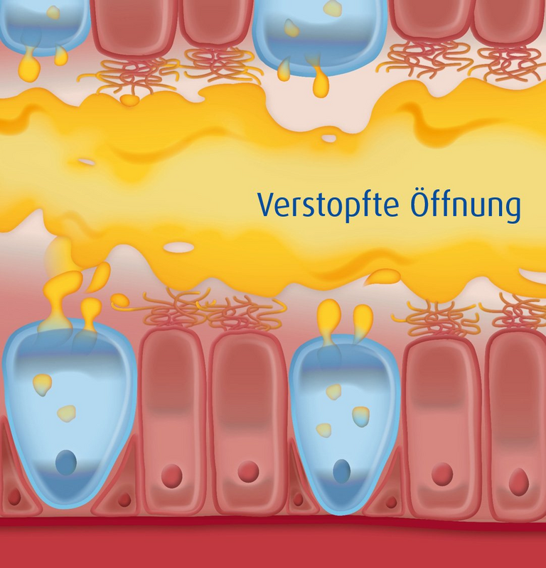 Abbildung Erreger im Körper bei verstopfter Öffnung